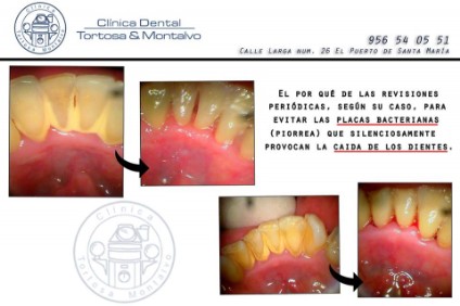 Caso clínico dental, Clínica Tortosa Montalvo