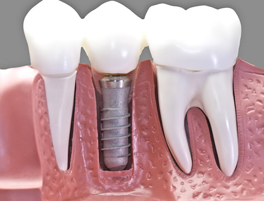implantes dentales Cádiz