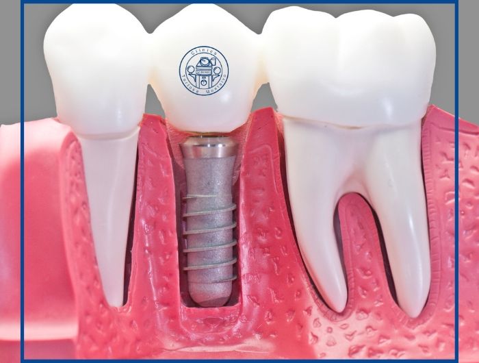 Implantes dentales en Cadiz, Clínica Tortosa Montalvo