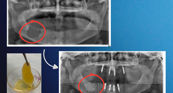 Endodoncia